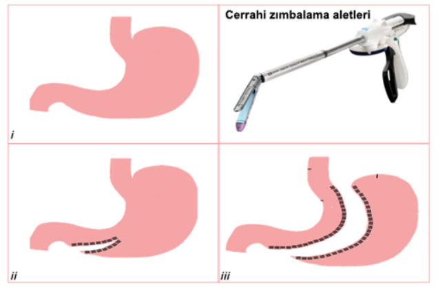 The Continuous Surgical Stapler developed by Sabancı University won first prize in the 8th Surgical Research Congress held by the Turkish Surgical Society